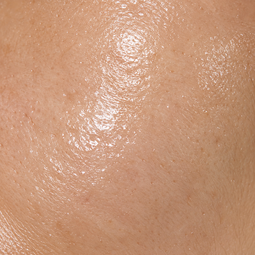 Oily Skin